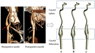 Frontiers | Hemodynamic evaluation of endarterectomy and stenting